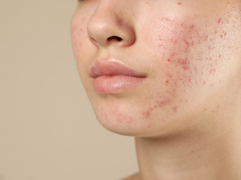 Types of Acne Scars: Treatment Guide Singapore