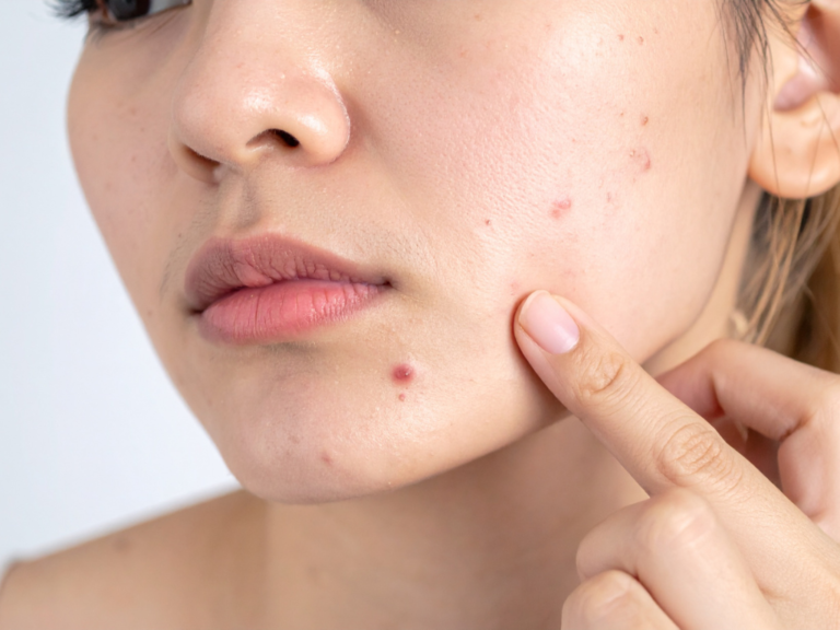Persistent Acne Singapore: Why Skincare Isn't Enough
