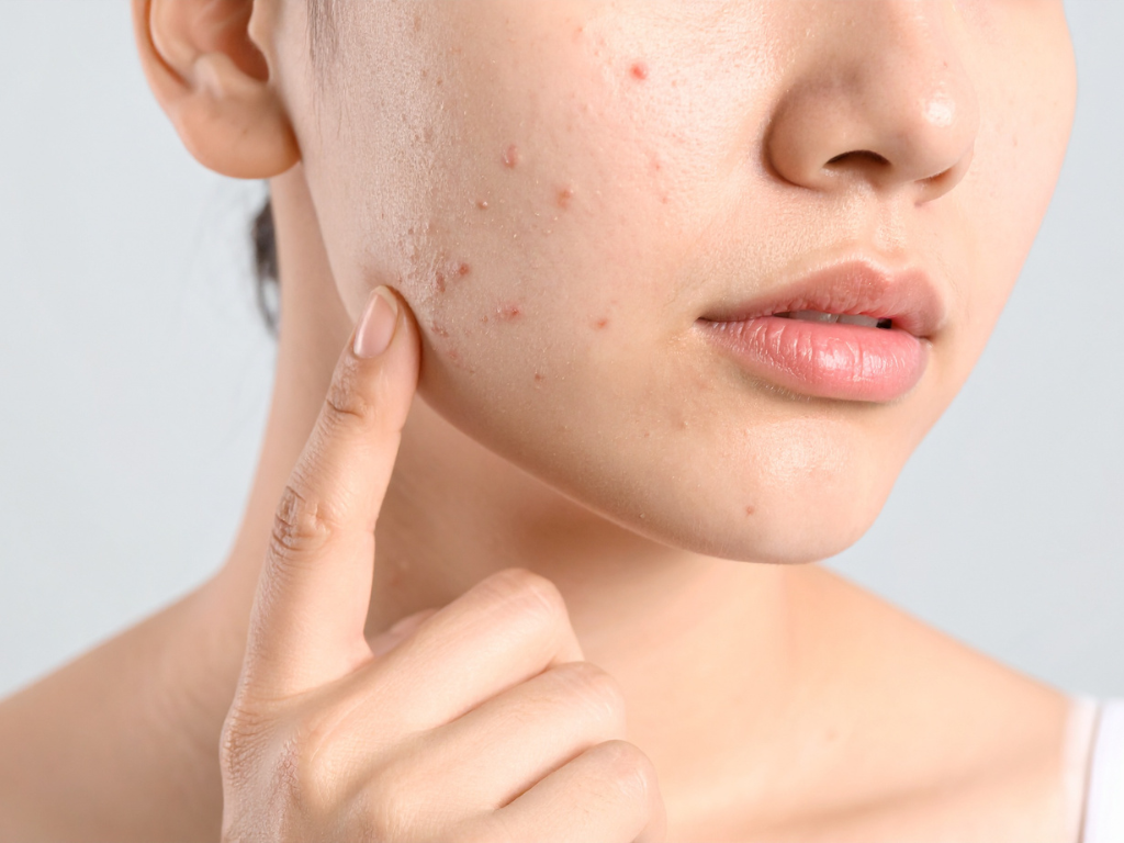 Why Acne Keeps Coming Back Despite a Full Shelf of Products 