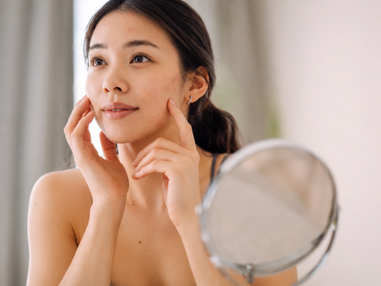 Acne Marks vs Acne Scars: What Fades, What Stays