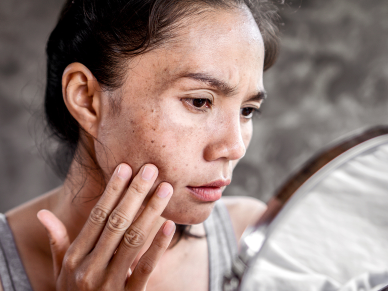 Why Is My Pigmentation Not Fading? What Keeps It Away