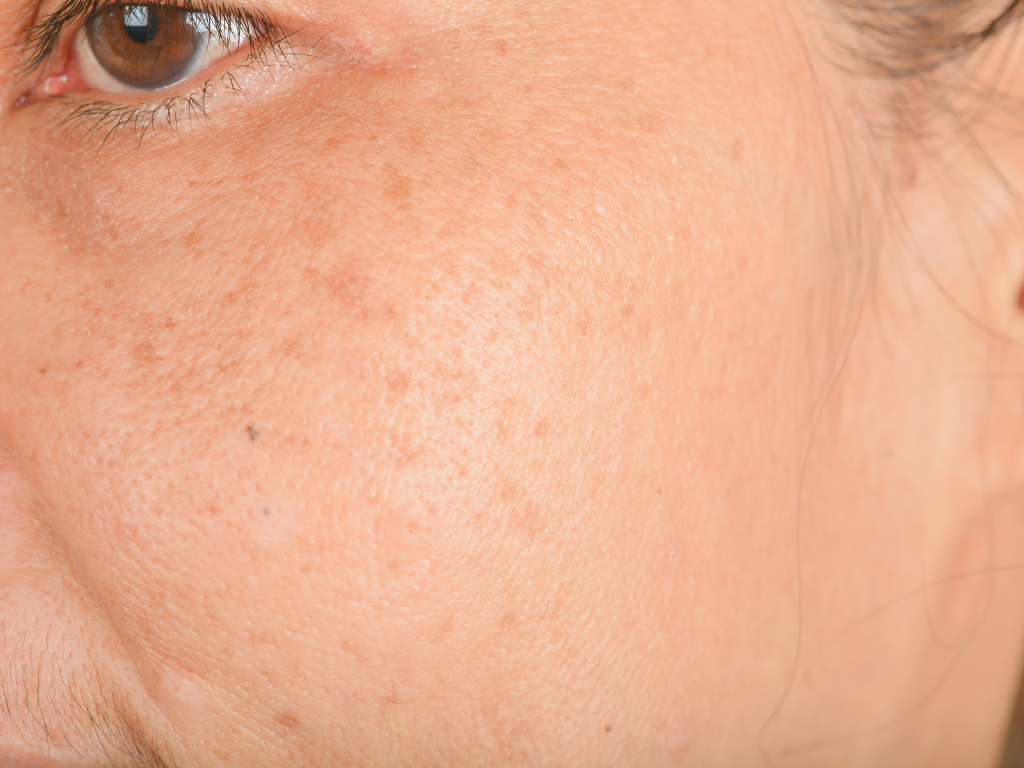 Why is my pigmentation not fading even though I'm treating it?
