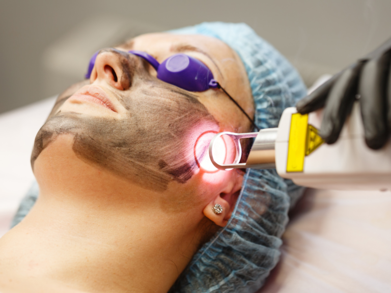 Can Laser Make Pigmentation Worse? Melasma Risks
