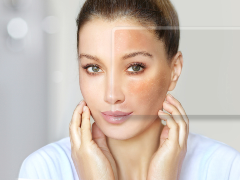 Melasma vs Hyperpigmentation: Which One Is It?
