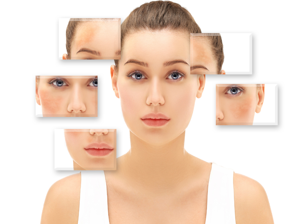 How do you tell melasma from post-inflammatory hyperpigmentation?
