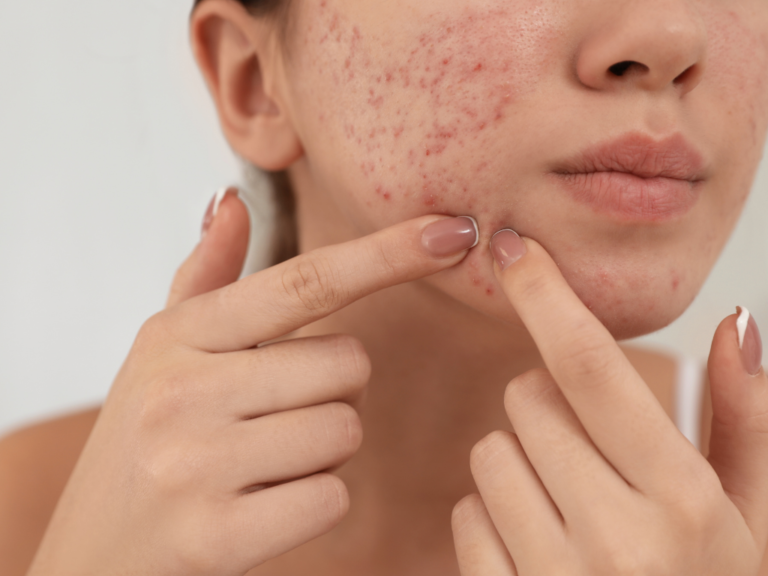 How to Fade Dark Marks From Acne (PIH)