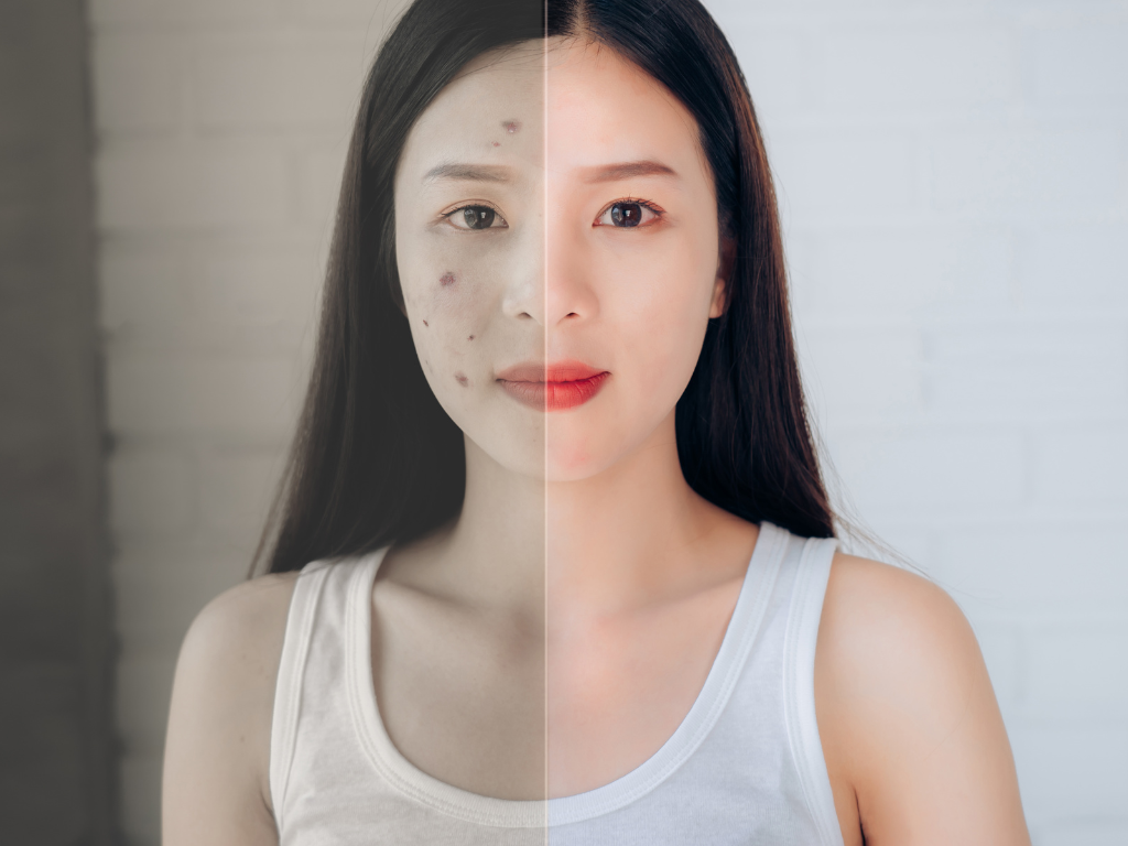What are the main types of facial pigmentation?

